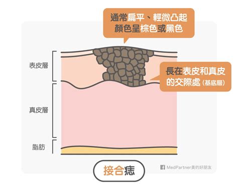 接合痣|點痣，原來這麼簡單－萊茵診所